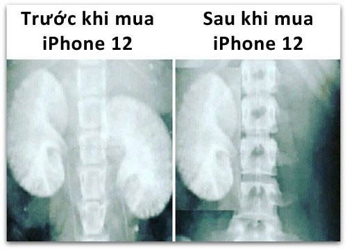 Ảnh X quang trước và sau khi mua iPhone 12: thiếu mất 1 quả thận