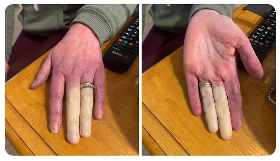Bàn tay người bị trắng ở hai ngón tay: ngón giữa và ngón áp út